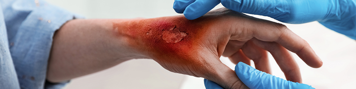 Our Services-Skin Burns